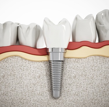 Illustration of a dental implant in Yukon in the jawbone