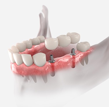 Dental bridge being attached to dental implants in Yukon