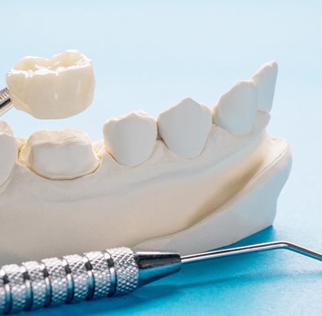 Dental crown being placed over a model of a tooth