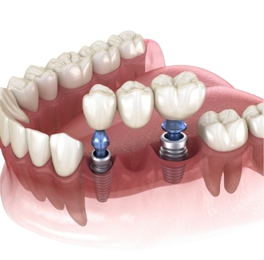 Illustrated dental bridge being fitted onto two dental implants