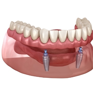 Illustrated implant denture being placed on the lower arch