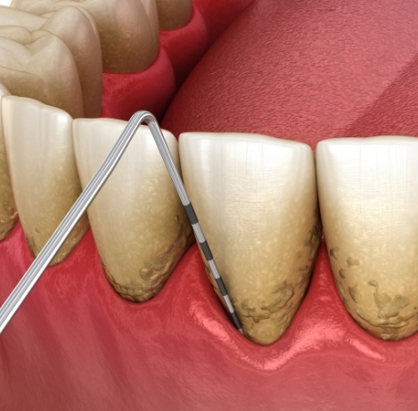 Illustrated dental probe treating gum disease