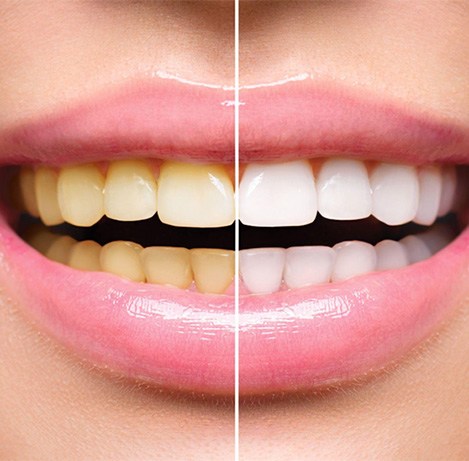 Before and after teeth whitening treatment